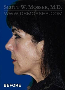 Chin Implant Patient 91901 Before Photo # 3