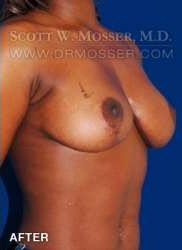 Breast Lift Without Implants Patient 95927 After Photo # 4