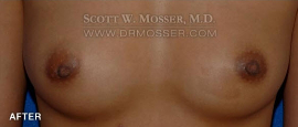 Nipple Inversion Correction Patient 38571 After Photo # 2