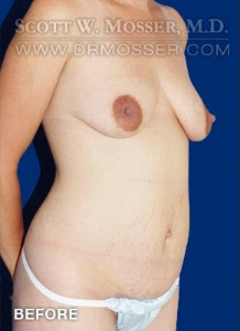 Mommy Makeover Patient 38394 Before Photo # 3