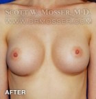 Breast Augmentation Patient 88566 After Photo Thumbnail # 2