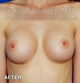 Breast Augmentation Patient 88566 After Photo # 2