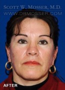 Upper Blepharoplasty Patient 92612 After Photo Thumbnail # 2
