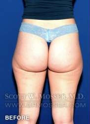 Liposuction - Thighs Patient 68368 Before Photo # 3