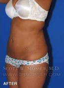 Liposuction - Abdomen & Flanks Patient 41506 After Photo Thumbnail # 6