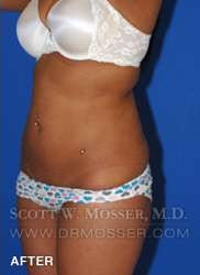 Liposuction - Abdomen & Flanks Patient 41506 After Photo # 6