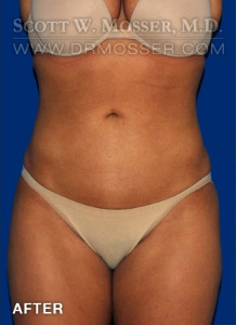 Liposuction - Abdomen & Flanks Patient 83778 After Photo # 2