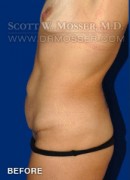 Abdominoplasty Patient 54737 Before Photo Thumbnail # 7