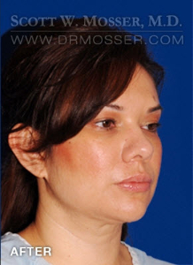 Liposuction - Face Patient 78389 After Photo # 4