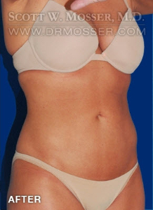 Liposuction - Abdomen & Flanks Patient 83778 After Photo # 4