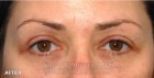Brow Lift Patient 82649 After Photo Thumbnail # 2