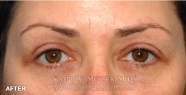 Brow Lift Patient 82649 After Photo # 2