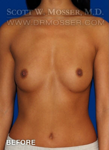 Breast Augmentation Patient 79638 Before Photo # 1