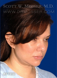Liposuction - Face Patient 78389 After Photo # 8