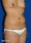 Liposuction - Abdomen & Flanks Patient 58519 Before Photo Thumbnail # 3