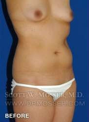Liposuction - Abdomen & Flanks Patient 58519 Before Photo # 3