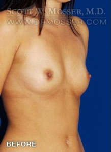 Breast Augmentation Patient 24873 Before Photo # 3