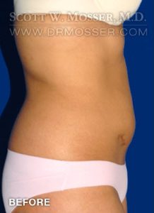 Liposuction - Abdomen & Flanks Patient 95887 Before Photo # 5