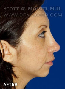 Rhinoplasty Patient 41083 After Photo # 4