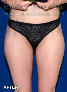 Liposuction - Thighs Patient 82329 After Photo # 2