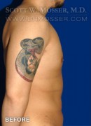 Liposuction - Chest Patient 38439 Before Photo Thumbnail # 5