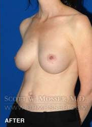 Breast Asymmetry Correction Patient 37996 After Photo # 8