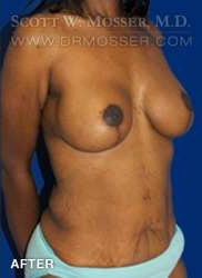 Breast Lift With Implants Patient 11670 After Photo # 6