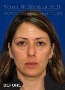 Upper Blepharoplasty Patient 94858 Before Photo Thumbnail # 1