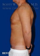 Liposuction - Chest Patient 51212 Before Photo Thumbnail # 5