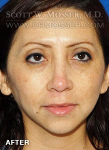 Rhinoplasty Patient 41083 After Photo # 2