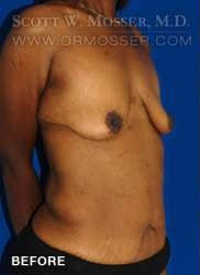 Breast Lift With Implants Patient 11670 Before Photo # 5