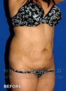 Liposuction - Abdomen & Flanks Patient 30590 Before Photo Thumbnail # 3