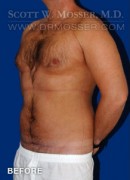 Liposuction - Chest Patient 51212 Before Photo Thumbnail # 3