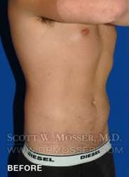 Liposuction - Abdomen & Flanks Patient 25141 Before Photo # 3