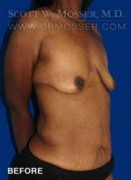 Breast Lift With Implants Patient 11670 Before Photo Thumbnail # 3