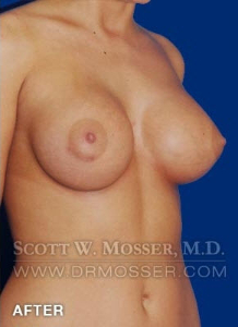 Breast Augmentation Patient 87318 After Photo # 4