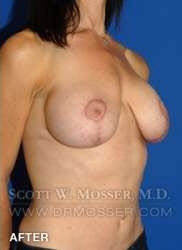 Breast Lift With Implants Patient 19074 After Photo # 4