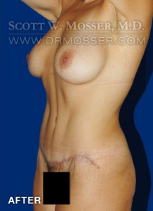 Abdominoplasty Patient 54737 After Photo # 6
