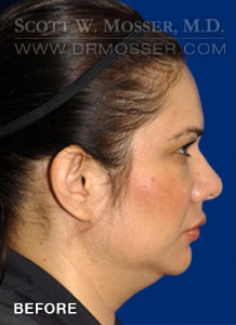 Liposuction - Face Patient 78389 Before Photo # 9