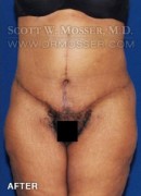 Lower Body Lift Patient 16603 After Photo Thumbnail # 2