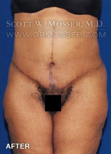 Lower Body Lift Patient 16603 After Photo # 2