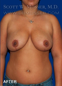 Breast Reduction Patient 20938 After Photo # 2