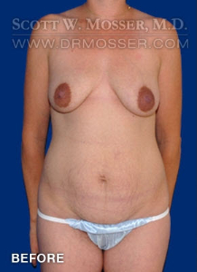 Abdominoplasty Patient 47187 Before Photo # 1