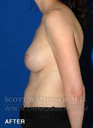 Breast Asymmetry Correction Patient 37996 After Photo # 4