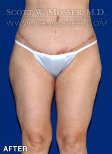Thigh Lift Patient 28030 After Photo # 2
