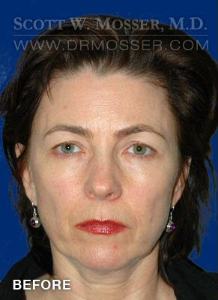 Chin Implant Patient 16572 Before Photo # 1