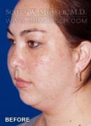 Chin Implant Patient 69285 Before Photo Thumbnail # 3