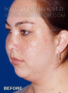 Chin Implant Patient 69285 Before Photo # 3
