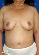 Breast Reduction Patient 54296 After Photo Thumbnail # 2