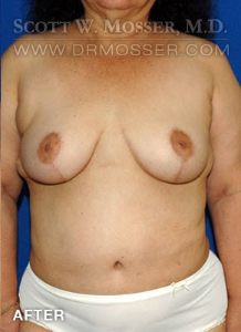 Breast Reduction Patient 54296 After Photo # 2